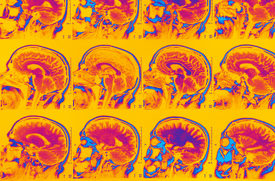 Images of MRI scans of a brain